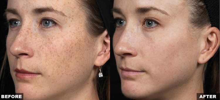 Fraxel Laser Treatment West Palm Beach Jupiter Skin Resurfacing
