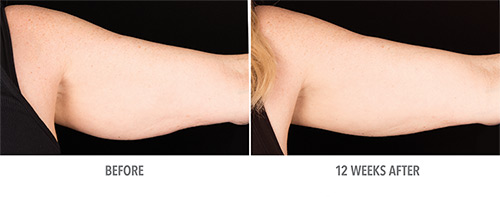Coolsculpting Before and After 13