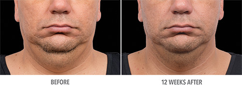 Coolsculpting Before and After 23