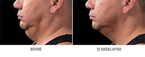 Coolsculpting Before and After 24