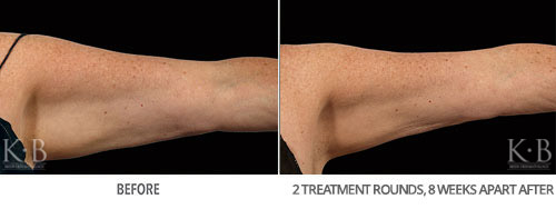 Coolsculpting Before and After 31