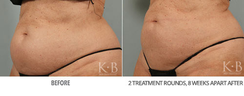 Coolsculpting Before and After 31