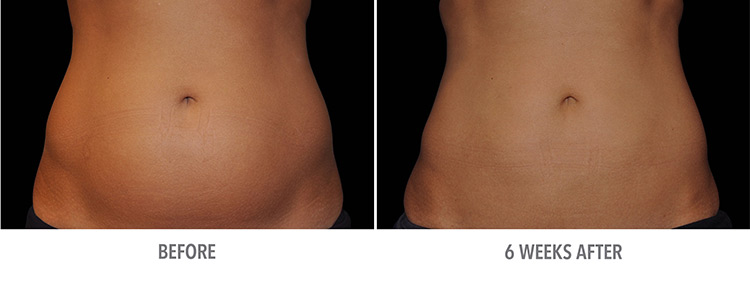 Coolsculpting Before And After 03