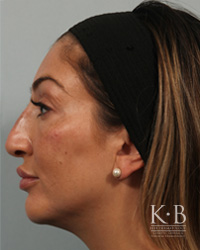 Restylane Before and After Actual patient result After image at Beer Dermatology, FL