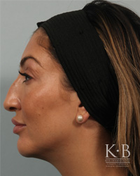 Restylane Before and After Actual patient result Before image at Beer Dermatology, FL