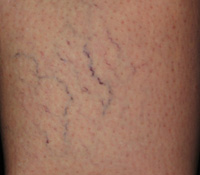 Sclerotherapy Before 01