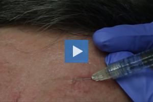 Injection of forehead lines - Dr. Kenneth Beer