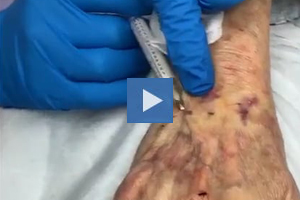 Ablative with Radiesse - Dr. Kenneth Beer