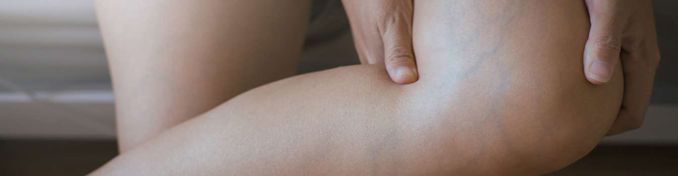 Sclerotherapy Banner Image
